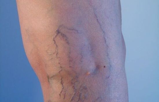 krčne žile na nogah pri ženskah