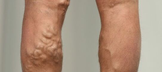 krčne žile na nogi