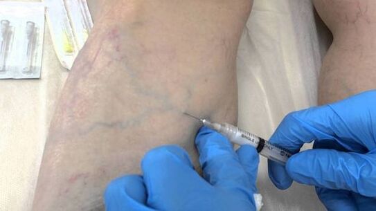 skleroterapija krčnih žil na nogah pri ženskah